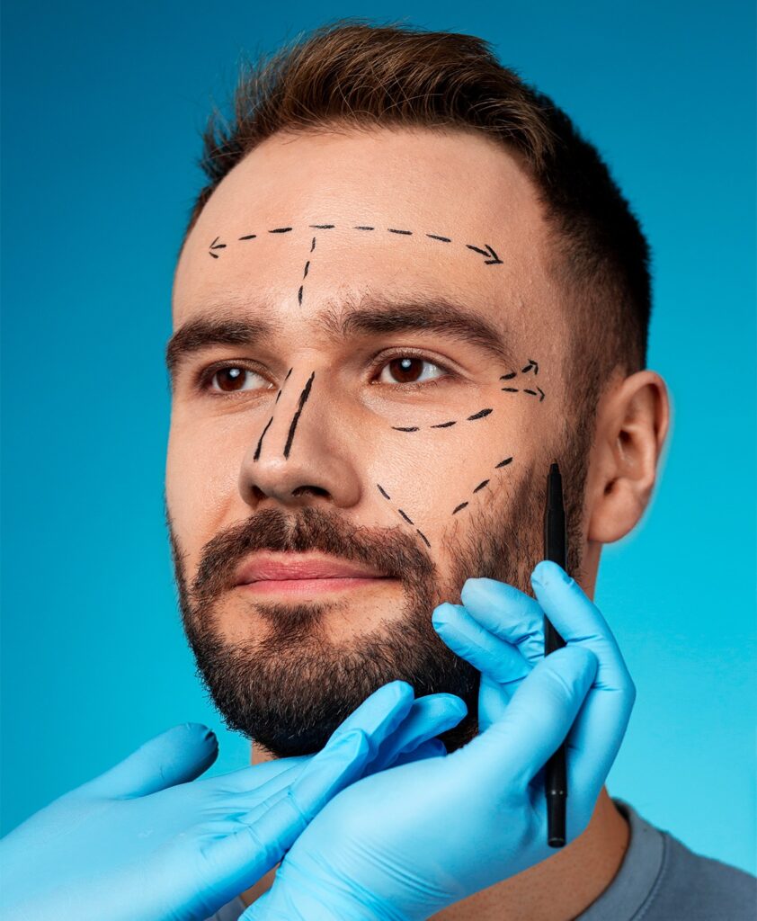 Male rhinoplasty planning marks