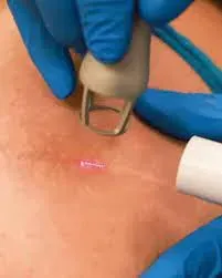 laser device on skin, scar therapy treatment