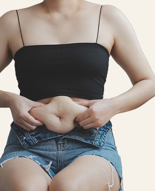 loose abdominal skin addressed with tummy tuck