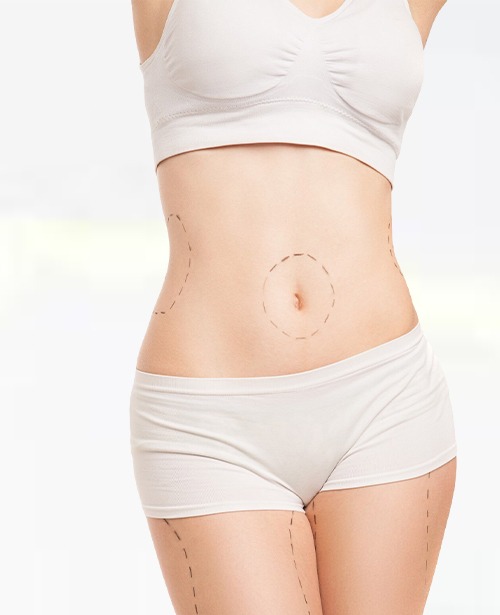 marked abdominal zones for planning tummy tuck surgery