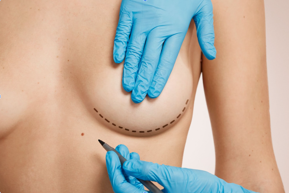 marking-session, nipple repair pre-procedure outline