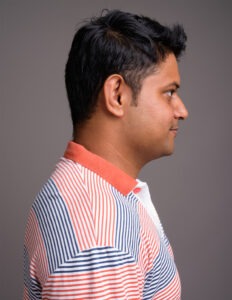 side-profile, male rhinoplasty healing stage, chicago