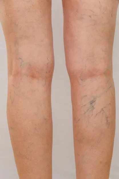 spider-vein legs, discoloration, cellulite vein care chicago