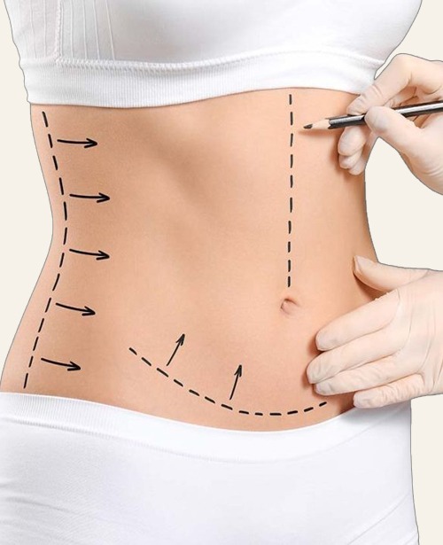 surgeon marking abdomen for tummy tuck planning