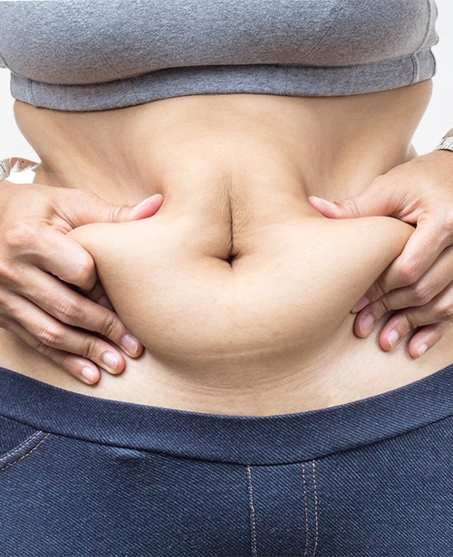 tummy tuck south barrington, abdominal skin fold check