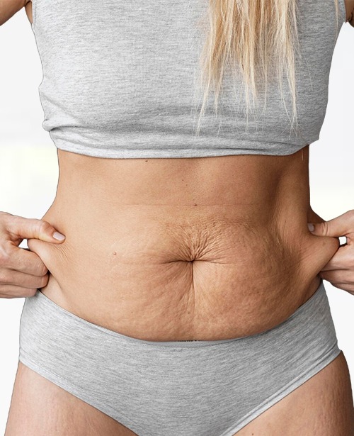 tummy tuck south barrington, loose skin evaluation