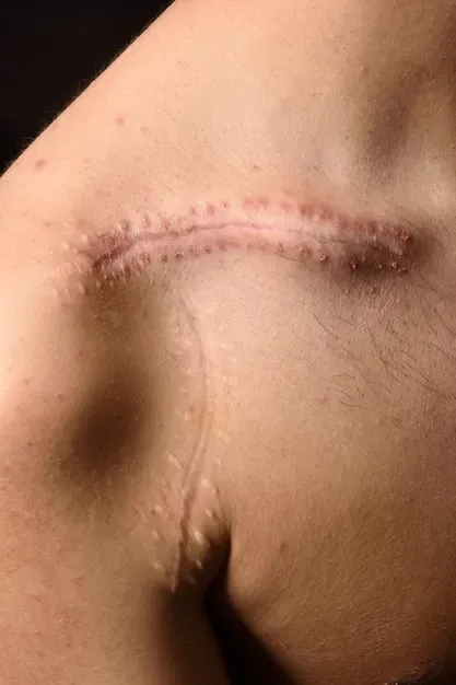 visible scar on skin, scar therapy chicago