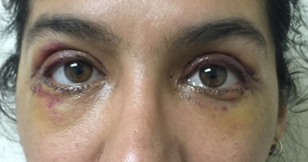 IMG_0591 eyelid 990x520 Before copy