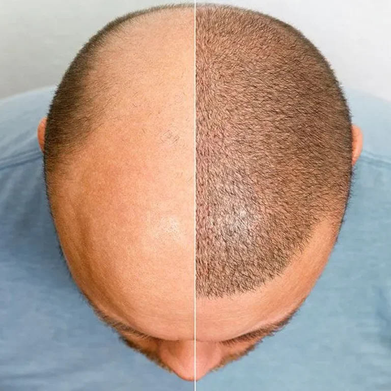 Are+There+Any+Specific+Criteria+or+Eligibility+Requirements+for+Individuals+Seeking+a+Hair+Transplant-CIBlog-18-01-24-01-1920w