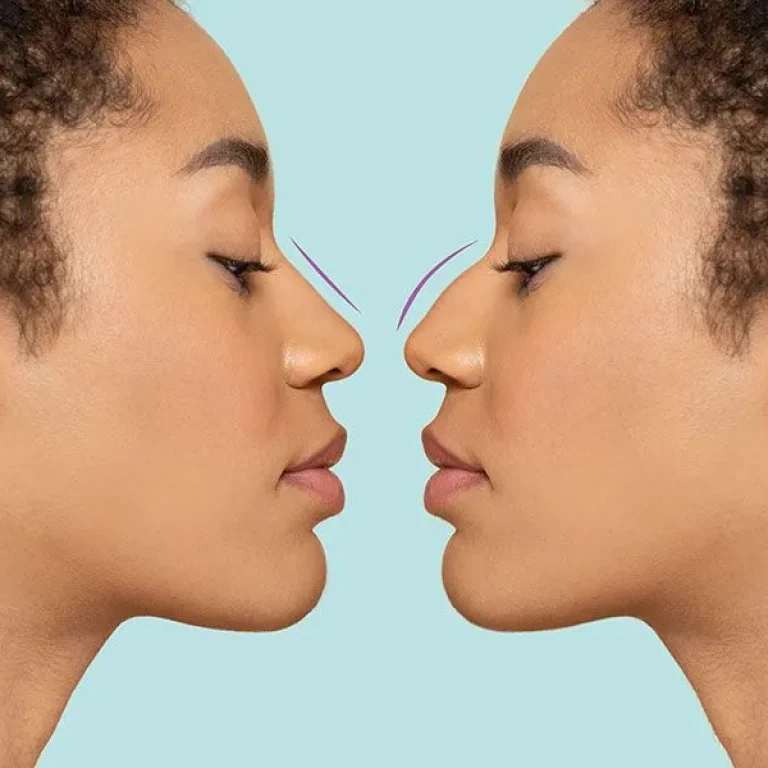 Blog-Considering+Rhinoplasty+Your+Complete+Guide+to+Nose+Reshaping+Surgery+(1)-1920w