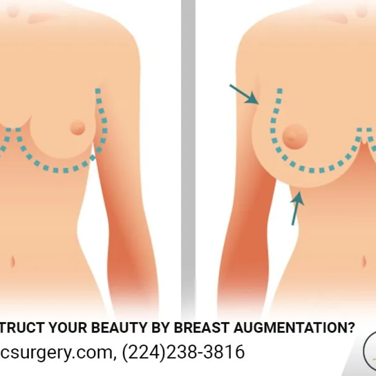 Breast Augmentation Surgery