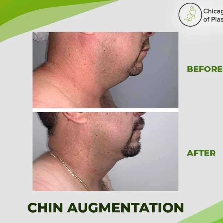 CHIN-AUGMENTATION-CI-PLASTIC-SURGERY-1920w