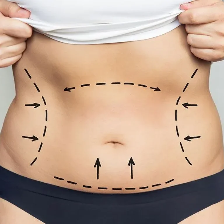 CIBLOG-Is+a+Tummy+Tuck+Right+for+You+Exploring+the+Benefits-+Risks-+and+Expectations+(1)-1920w