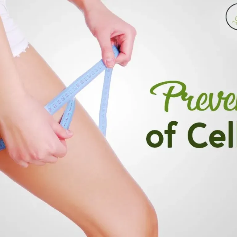Cellulite+Reduction+Treatment++Causes,+Prevention,+Definition,+Procedure,+How+It+Works-1920w