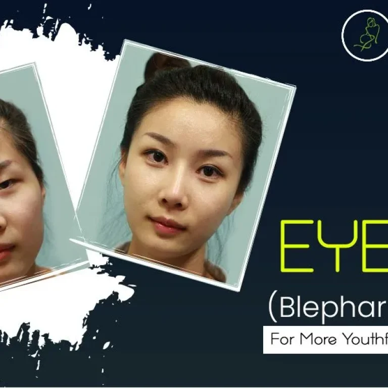 “Eyelid+(Blepharoplasty)+–+For+More+Youthful+Appearance”-1920w
