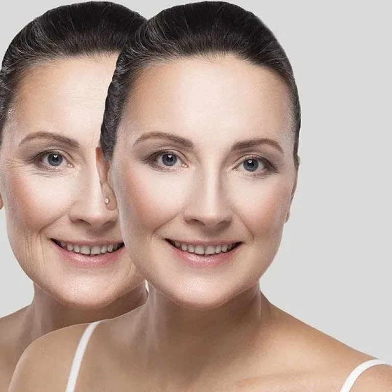 How+Long+Do+the+Effects+of+Double+Chin+Liposuction+Persist-Blog+(1)-1920w