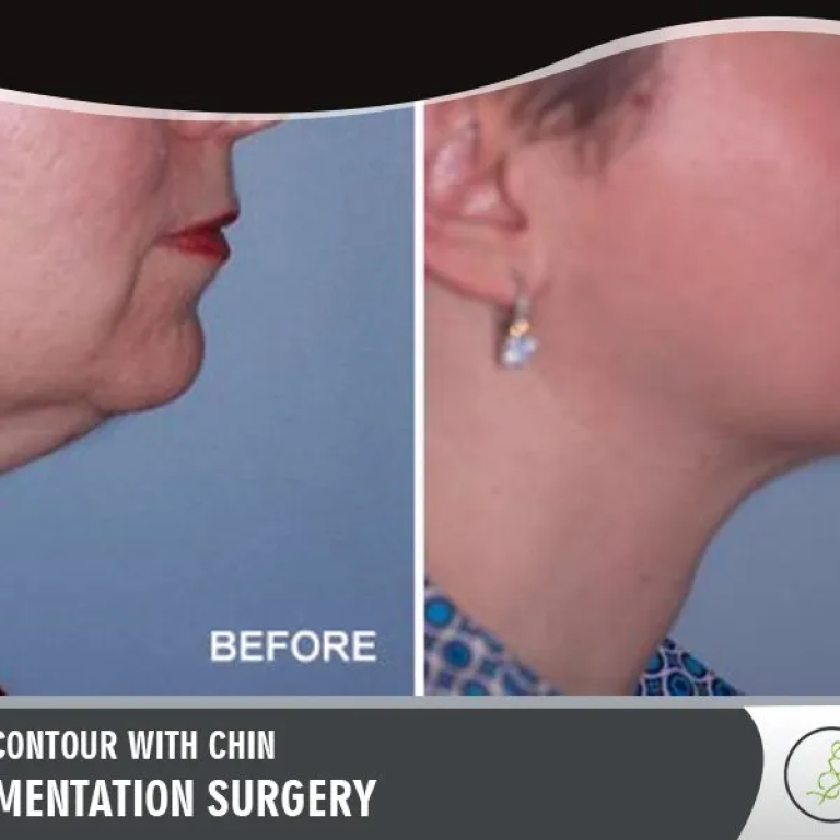 Improve+Facial+Contour+With+Chin+and+Cheek+Augmentation+Surgery+(1)-1920w