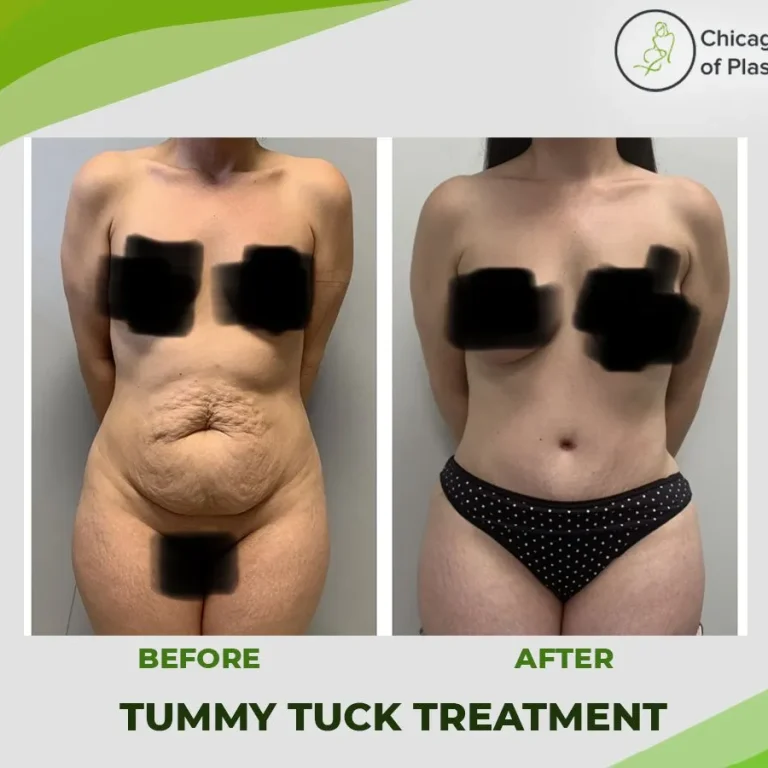 Reduce+Your+Belly+Fat+with+Tummy+Tuck+Treatment-1920w