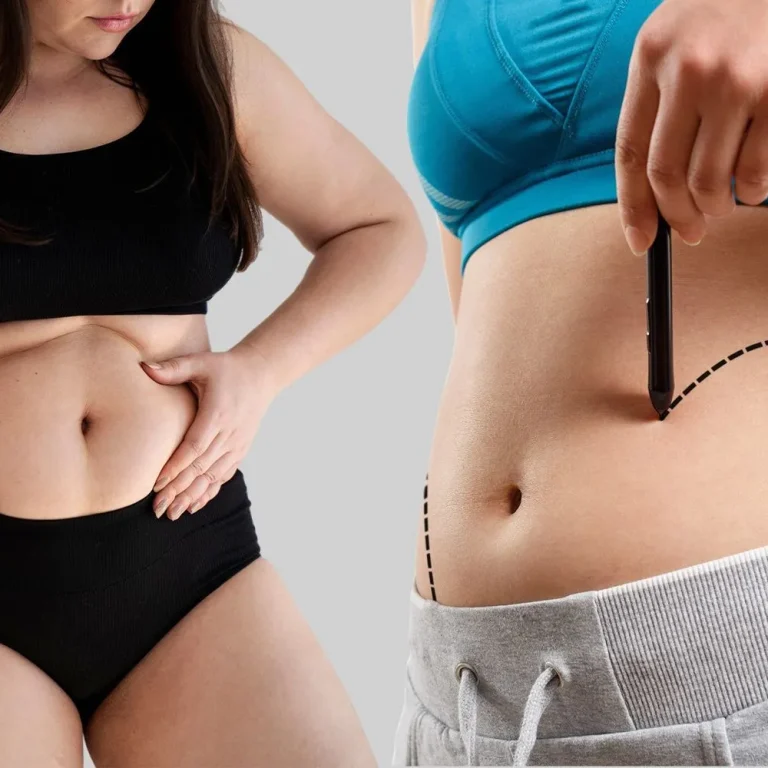Tummy+Tuck+Vs.+Liposuction+Which+Procedure+Is+Right+for+You+(1)-1920w