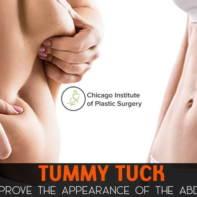 Tummy+Tuck+–+A+Surgical+Procedure+to+Improve+the+Appearance+of+the+Abdomen-1920w