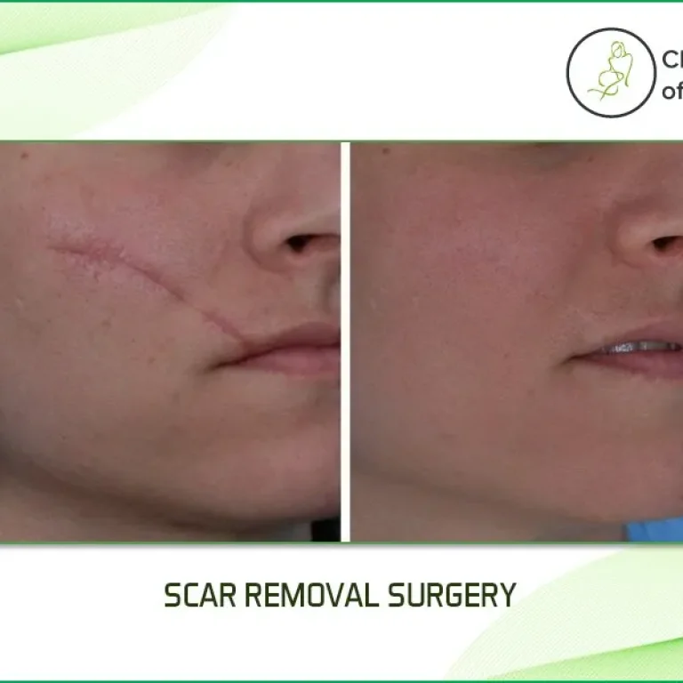 What+is+Scar+Removal+Surgery-What+are+the+Types+of+Scars+and+Their+Treatments-1920w
